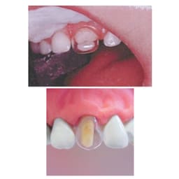 Tor Vm Transparent Crowns 64 pcs - Premolar No. 1.911P - 4