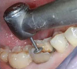 NewDiamond Diamond Bur WH-13 (Pack Of 3)