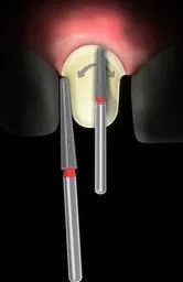 Frank Dental Tapered Round Diamond Bur TR Series (Fine)