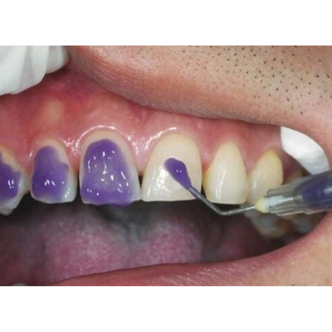 Prime Dental Restorite Etching Gel 3ml