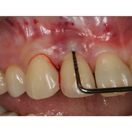 GDC Marking Probe -3 (Pow6)