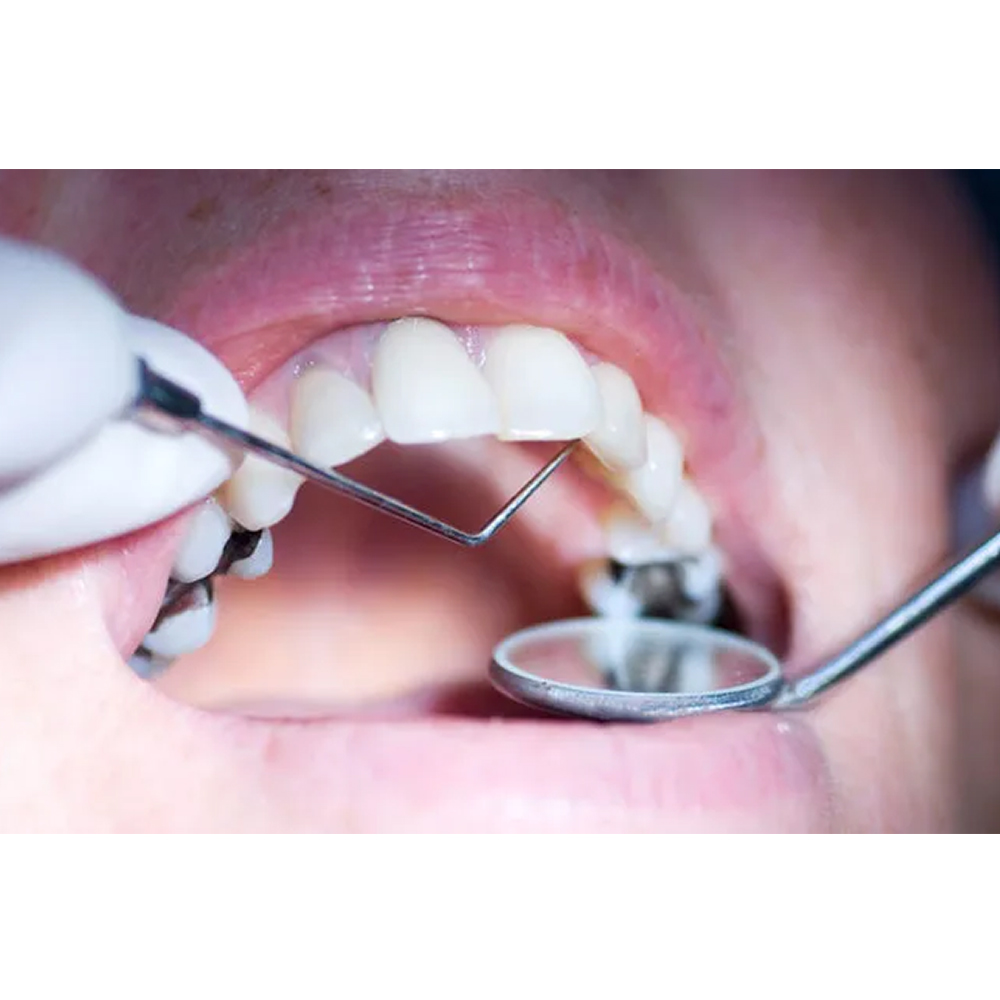 GDC Single End Probe -3 (Exs6l)