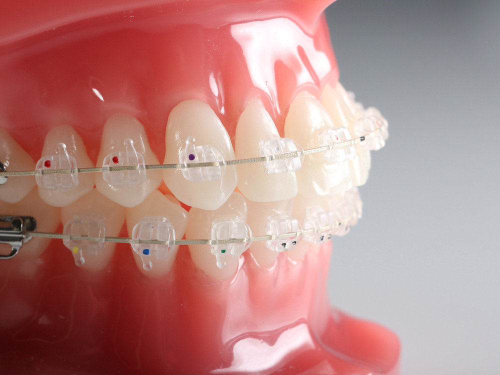 Ceramic Bracket Kit MBT 0.022