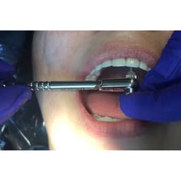 Nextin Dental Implant Prosthetic Hex Drivers - 4