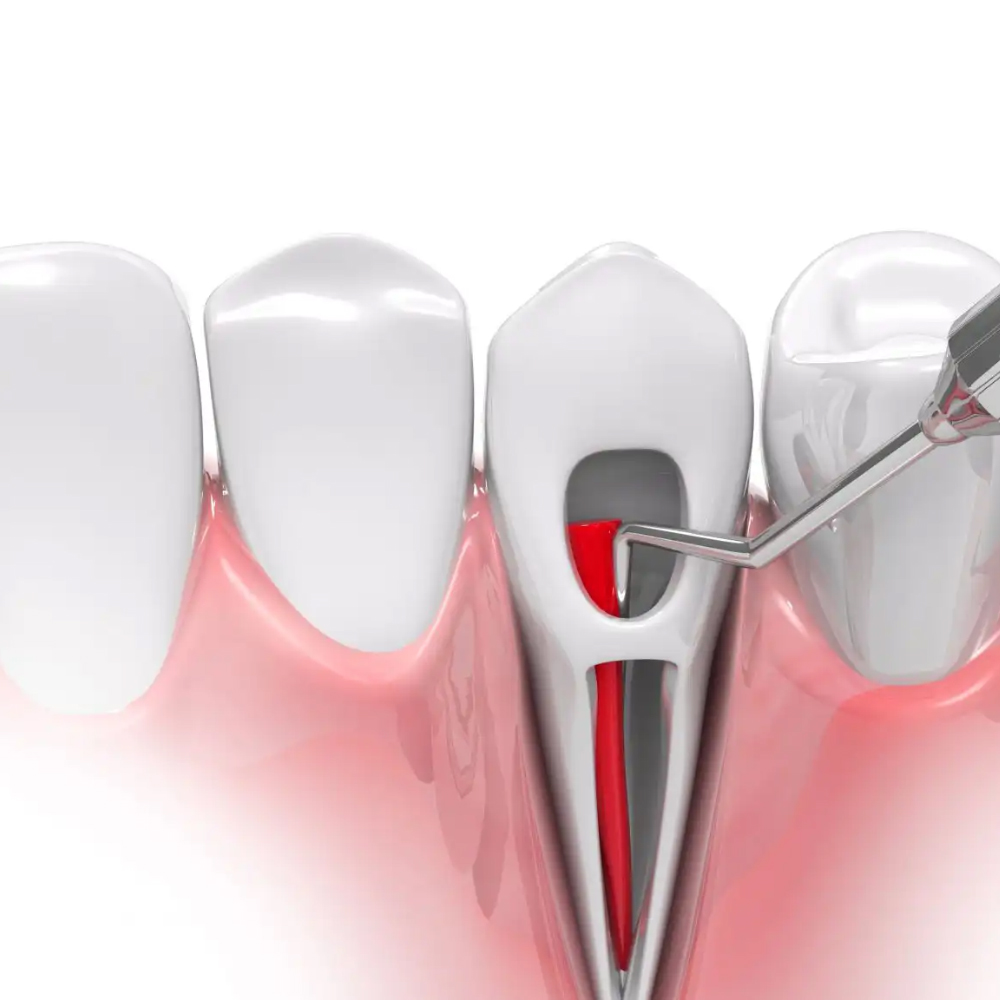 GDC Root Canal Plugger (.40mm) RCP40 #3