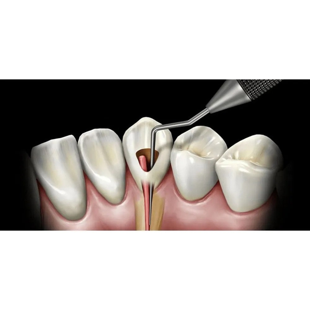 GDC Root Canal Plugger Luks - (.50mm) (.75mm) RCP5/7 #3