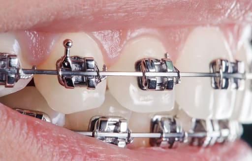 Phyx Preformed SS Archwire Rectangle (Pk of 10)