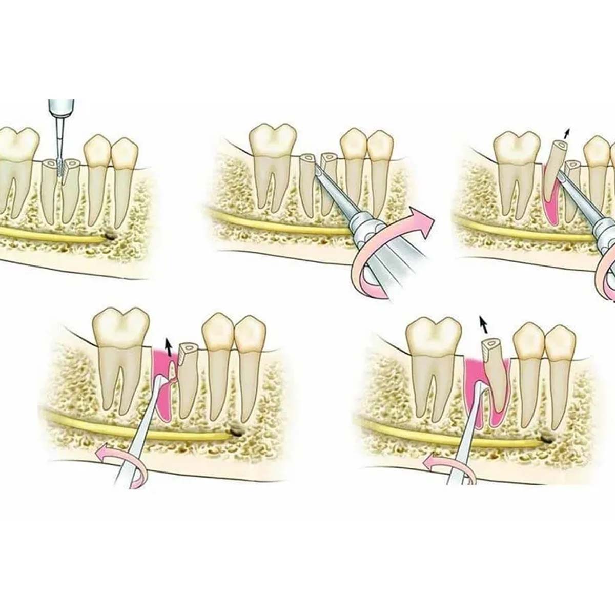 Oracraft Root Elevator Set Of 9 In Pouch - RESP9