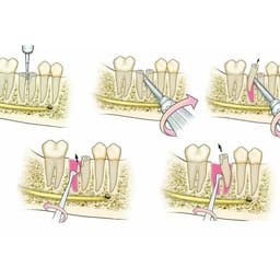 Oracraft Root Elevator Set Of 9 In Pouch - RESP9 - 9