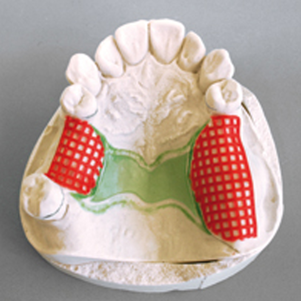 Maarc Retention Mesh