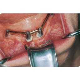 GDC University Of Minnesota Retractor (140mm) CRM - 7