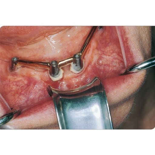 GDC University Of Minnesota Retractor (140mm) CRM