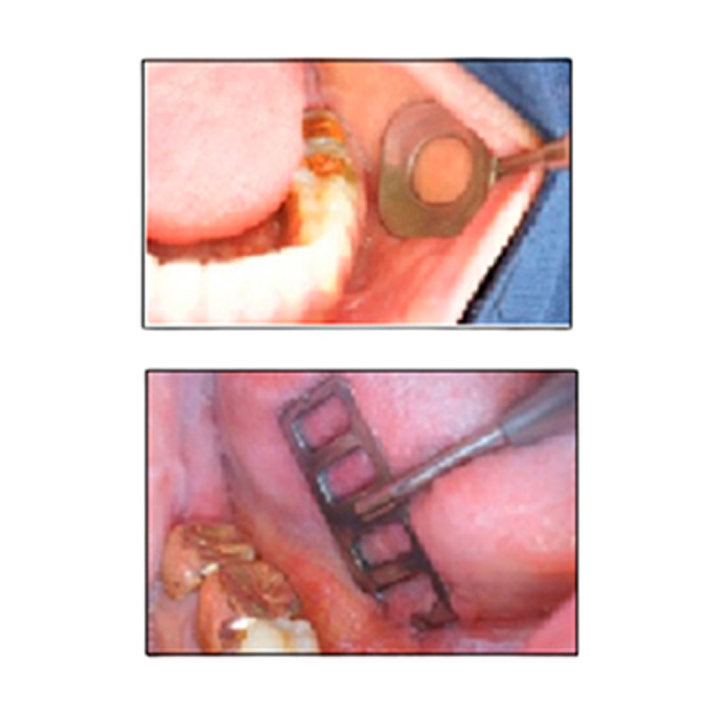 Julldent Cheek Tongue Lip Retractor And Handle