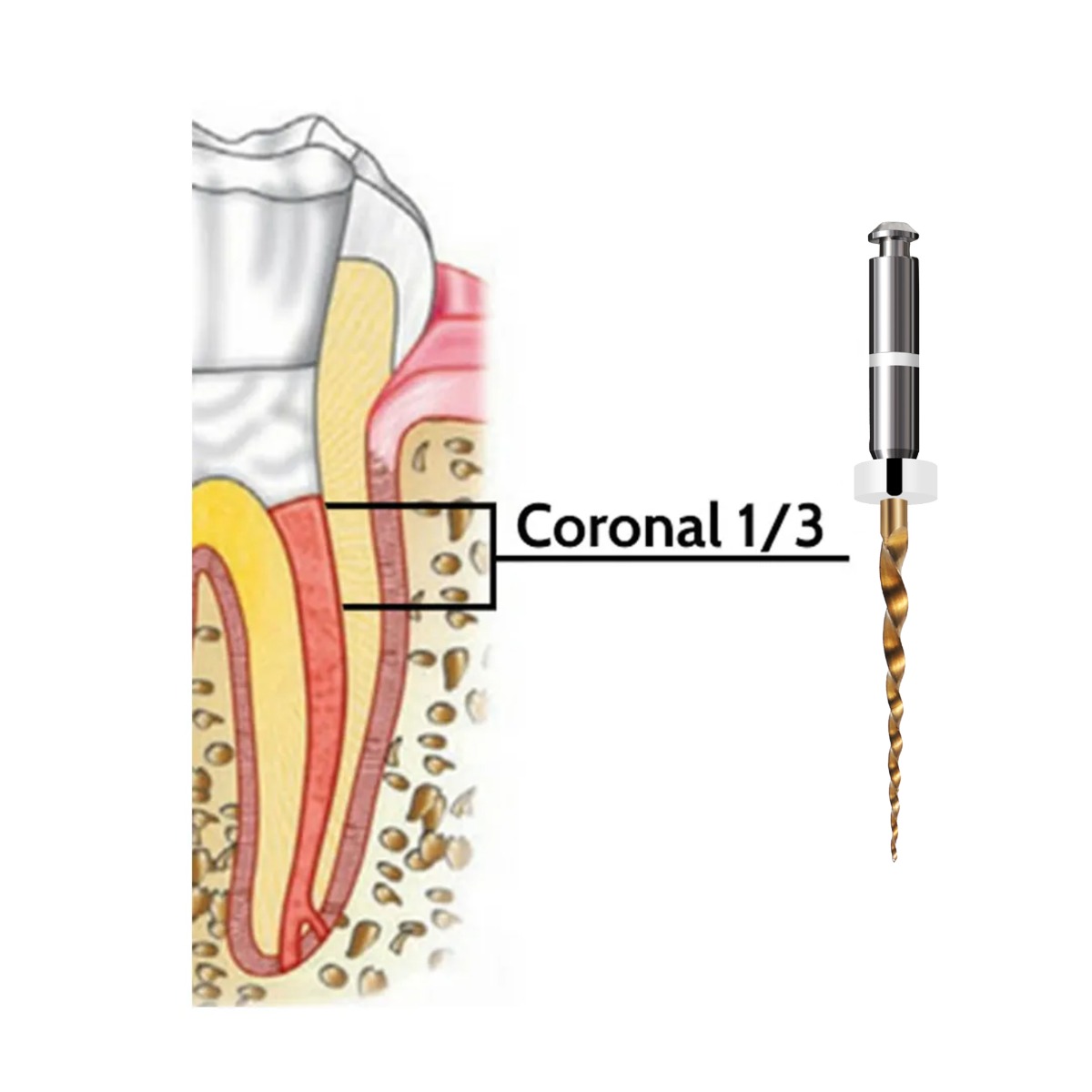 Waldent Retreatment Rotary Files