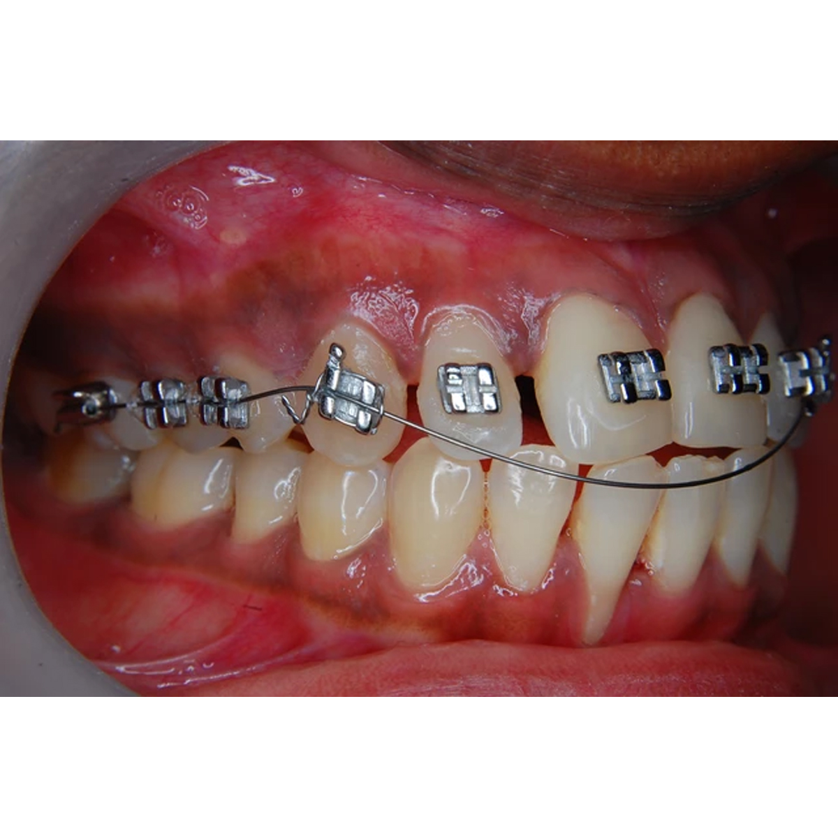 Prime Ortho Reverse Curve (RCS) Orthodontic Niti Archwires Rectangular (Pack of 10)