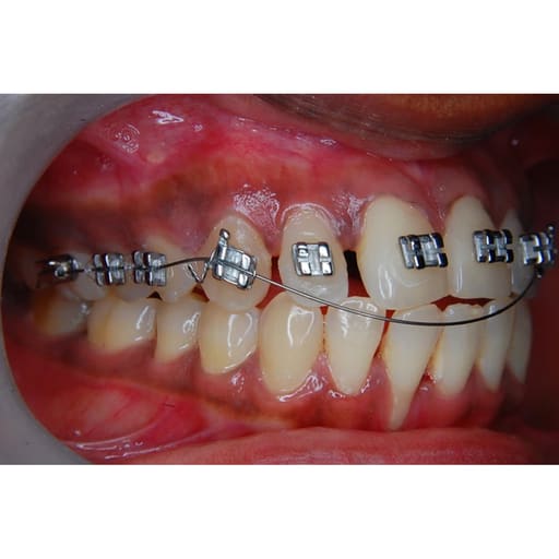 Prime Ortho Reverse Curve (RCS) Orthodontic Niti Archwires Rectangular (Pack of 10)