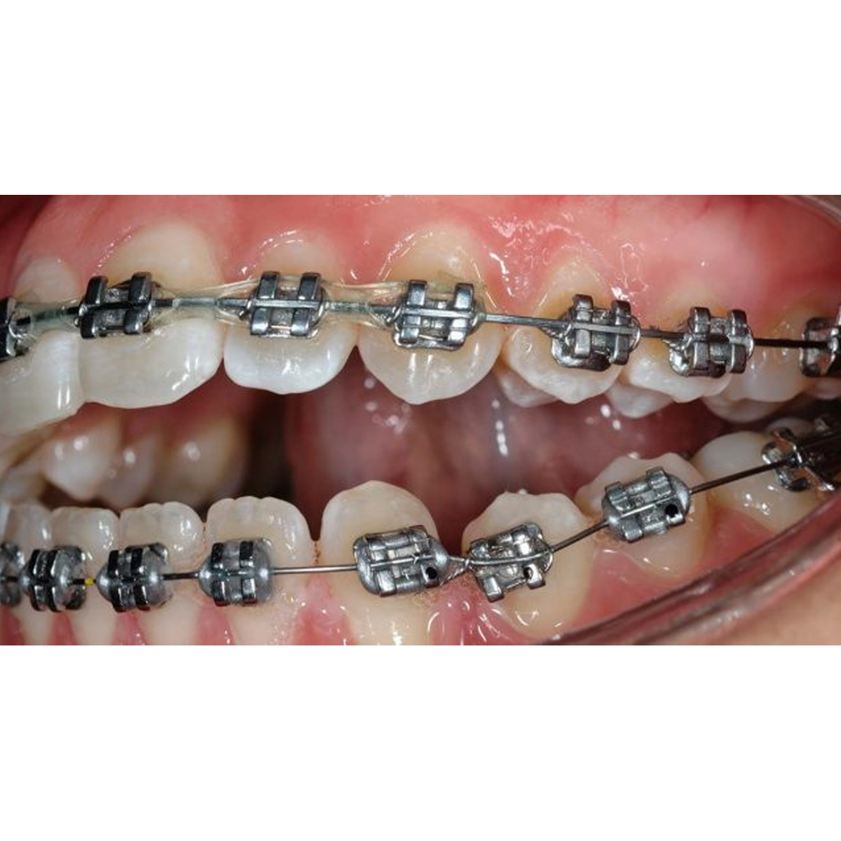 Prime Ortho Reverse Curve (RCS) Orthodontic Niti Archwires Rectangular (Pack of 10)