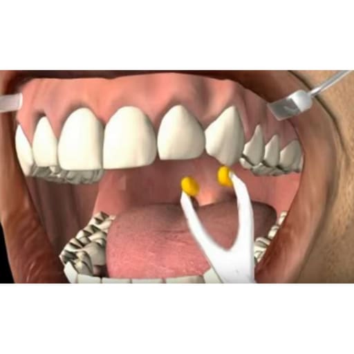 GDC Temporary Crown Removing Plier CR4562