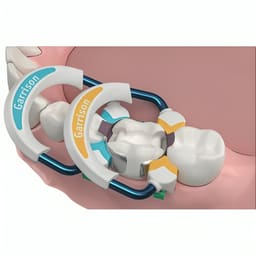 Garrison Dental Strata-G Sectional Matrix System Standard Kit (SG-KS-40) - 10