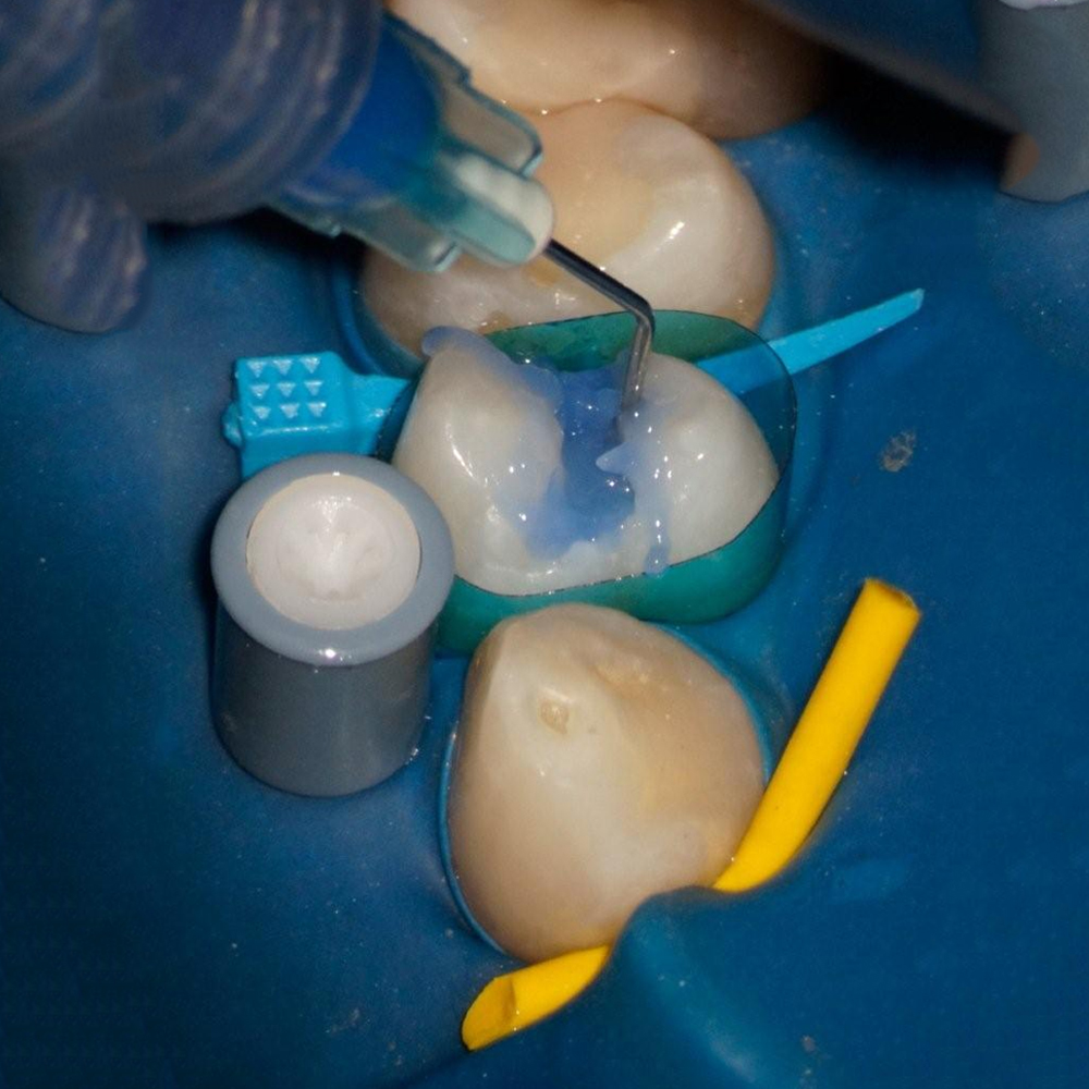 Garrison Dental ReelMatrix Margin Elevation Matrices (RM500H) - Pack of 50 