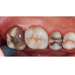 Garrison Dental ReelMatrix Margin Elevation Matrices (RM500H) - Pack of 50  - 5