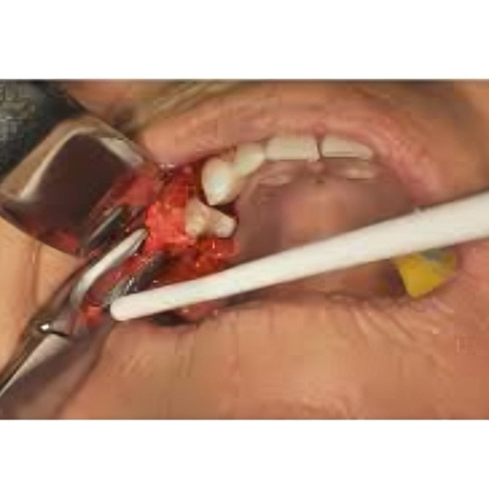 Oracraft Blumenthal Bone Rongeurs