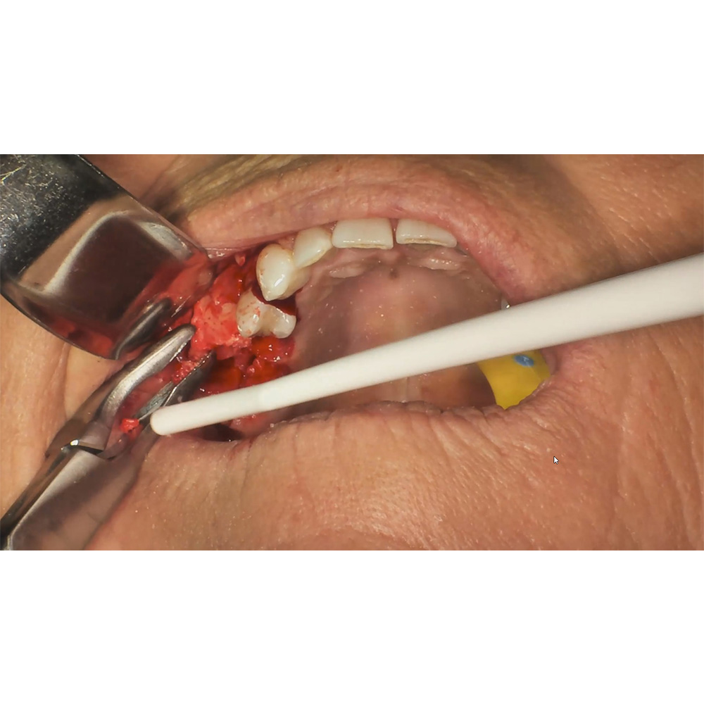 GDC Micro Bone Rongeurs