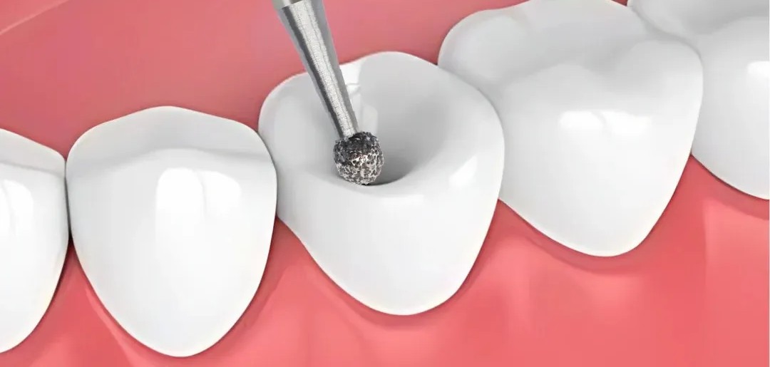 Frank Dental Ball Round FG Diamond Bur - Pack of 10