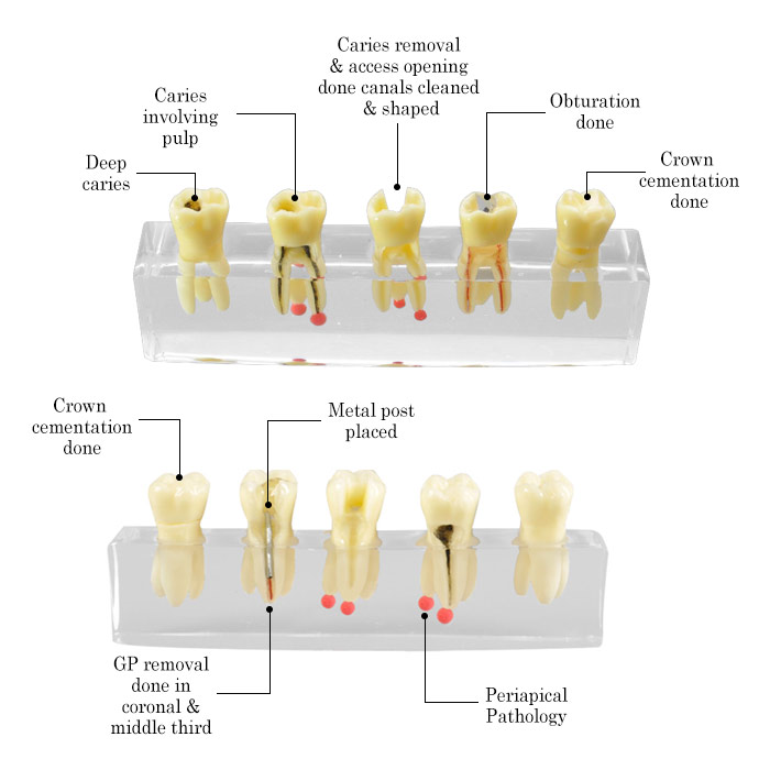 iDENTical Root Canal Model M4012