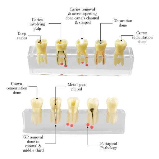 iDENTical Root Canal Model M4012