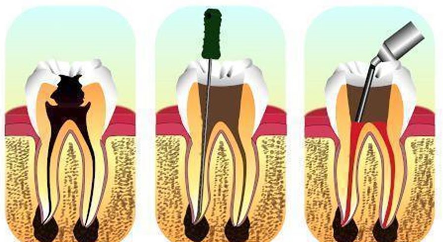 Maarc D-Vitz Pulp Devitalizer 3gm Syringe