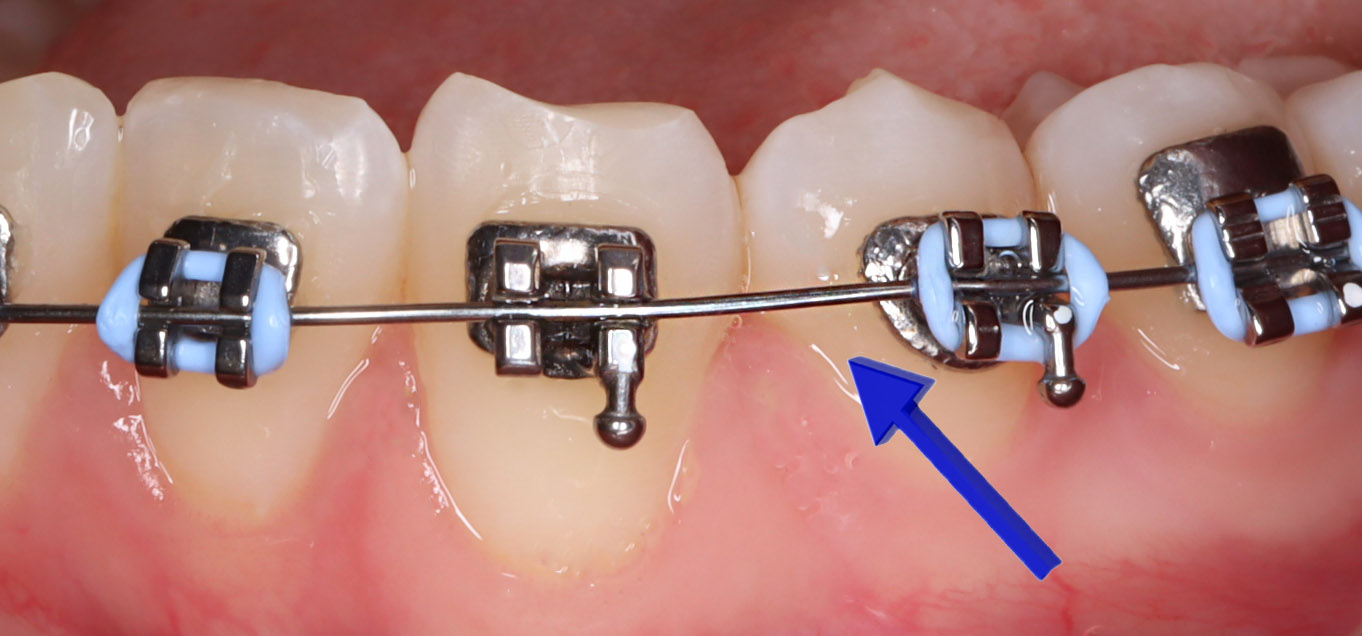 Ortho Organizers Stainless Steel Archwires Euro / Oval Form - Rectangular (25/Pk)