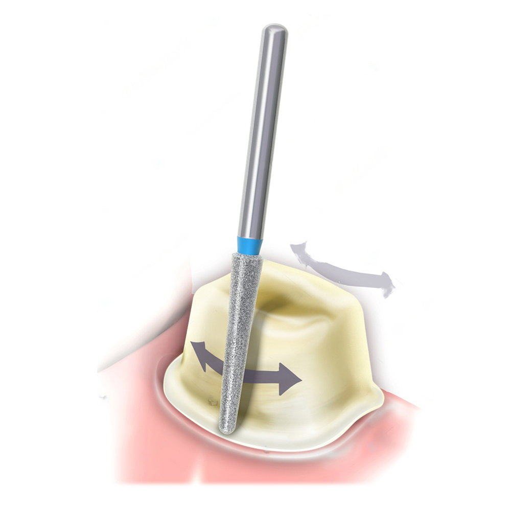 NewDiamond Rounded Shoulder Diamond Bur -RS (Pack Of 3)