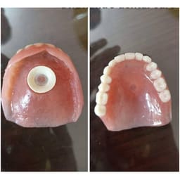 MDM Y - Dents Denture Suction Chamber Rubber Discs - 5