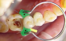 Tor Vm Rings - 10