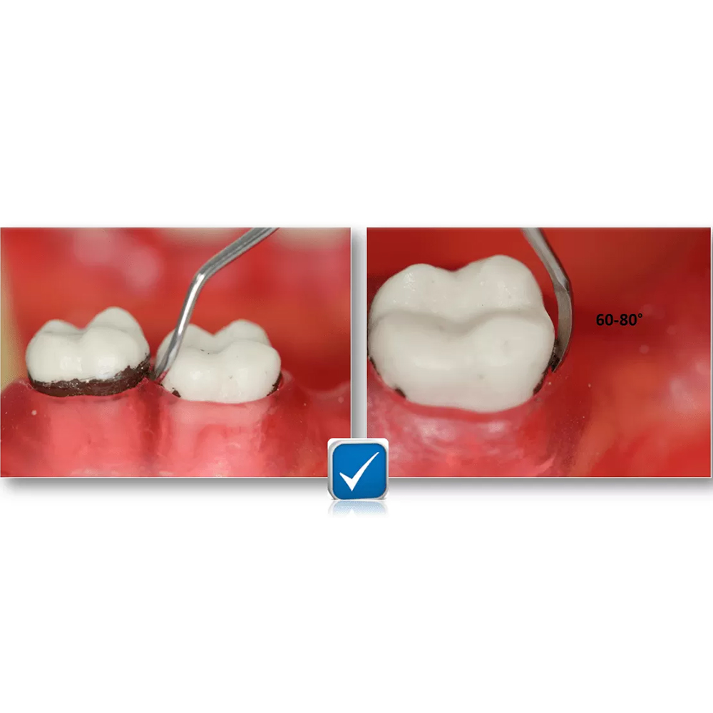 GDC Sickle Scalers Posterior #6 (S204s)