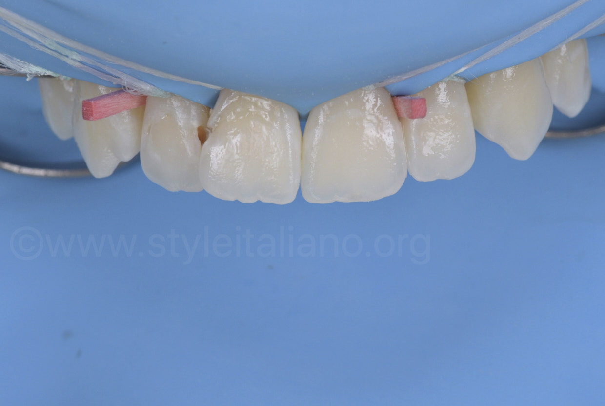 Tor Vm Wooden Wedges