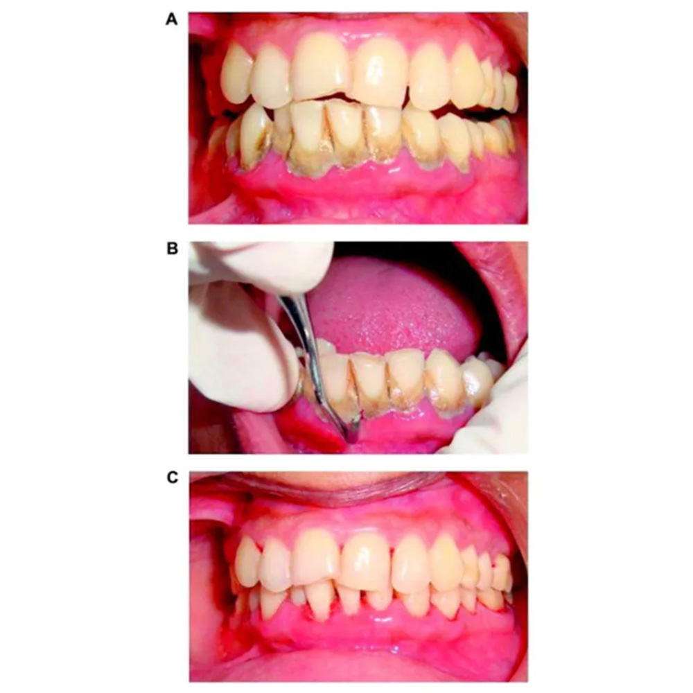 Veecare Premium Scaler Set of 3 With Cassette