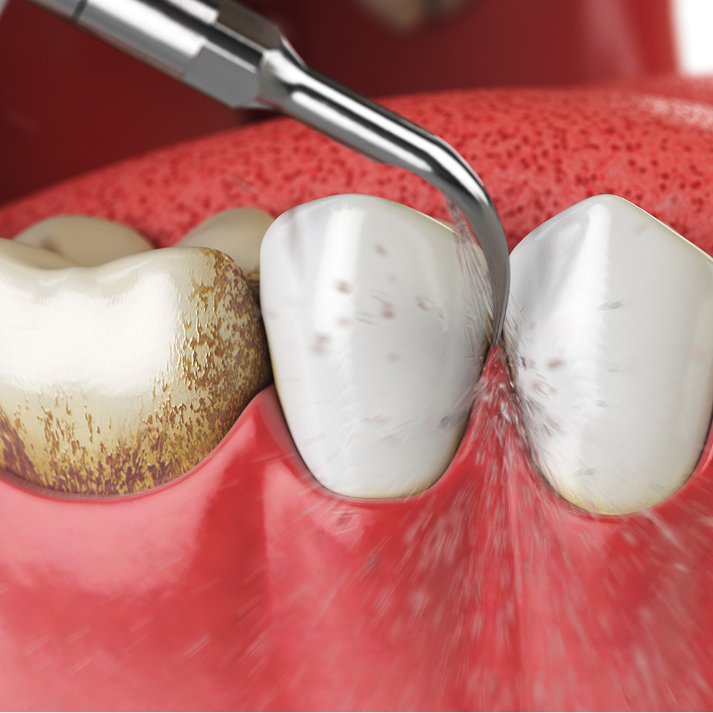 Waldent Anytooth Ultrasonic Scaler Tips Kit (Satelac, DTE, NSK Type) 