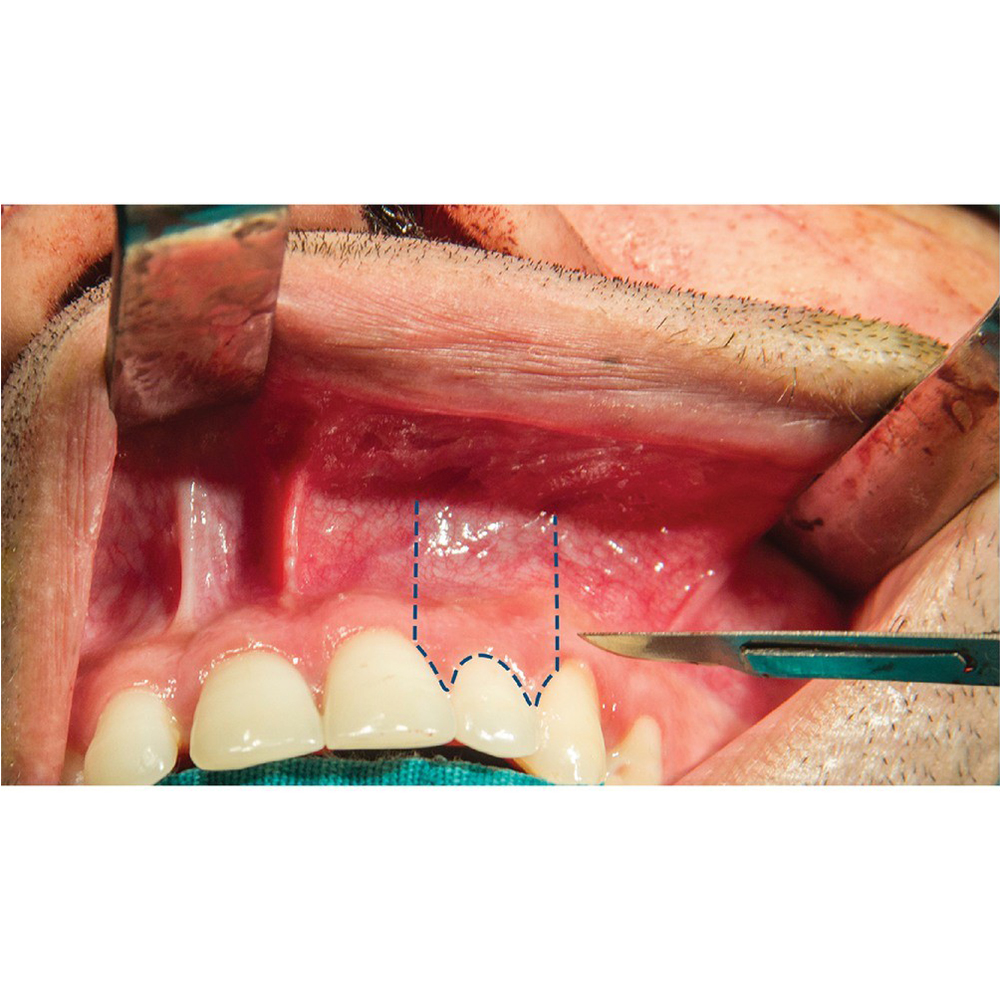 GDC Scalpel Solid Handle Straight 14.5cm (10-130-5EM)