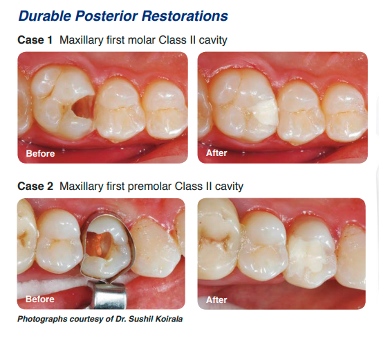 Shofu Zirconomer Improved