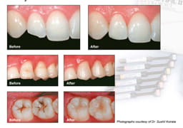 Shofu Beautifil II Dental Composite Basic Kit - 8