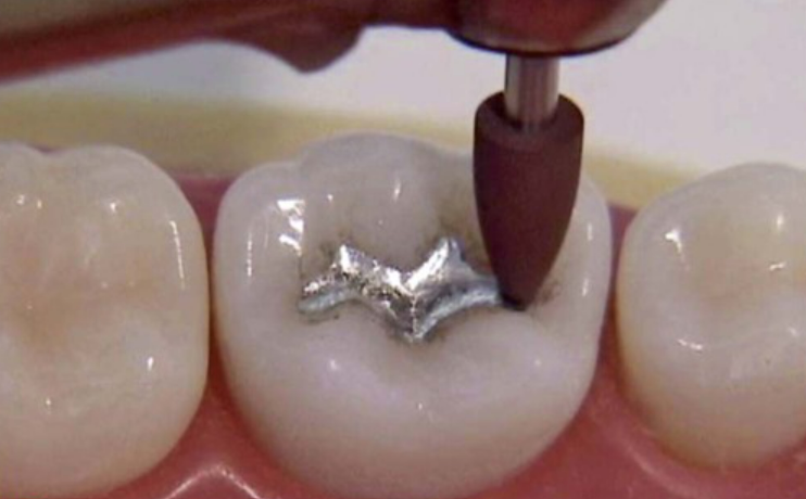 Shofu Amalgam Polishing Kit Fg/Ca