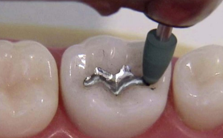 Shofu Amalgam Polishing Kit Fg/Ca