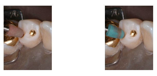 Shofu Gold Polishing Kit Ca/Hp