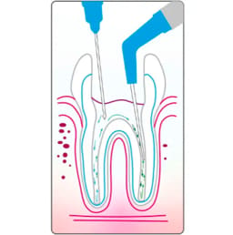 Cotisen Endodontic Aspirator Tip ( Pack of 1 ) - 14