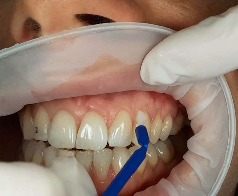 Prevest Shield Activ