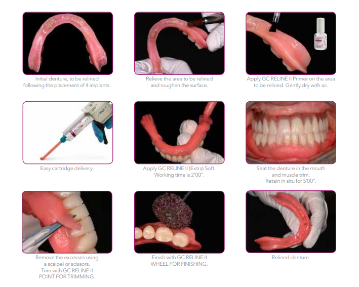 GC Reline II Soft Intro Kit
