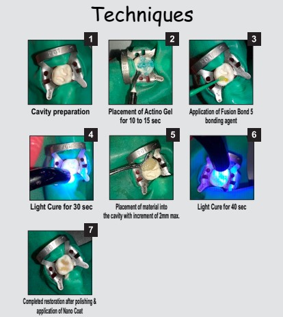 Prevest Fusion Universal Composite Kit