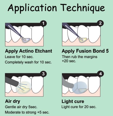 Prevest Fusion BOND 5